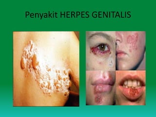 Penyakit HERPES GENITALIS
 