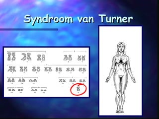 Syndroom van TurnerSyndroom van Turner
 
