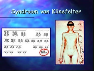 Syndroom van KlinefelterSyndroom van Klinefelter
 