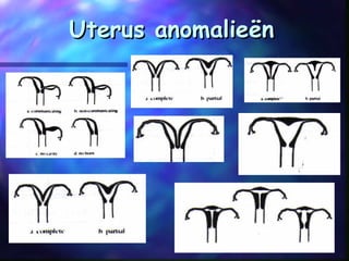 Uterus anomalieënUterus anomalieën
 