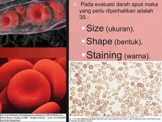  Pada evaluasi darah apus maka
  yang perlu diperhatikan adalah
  3S :

    Size (ukuran).
    Shape (bentuk).
   Staining (warna).
 