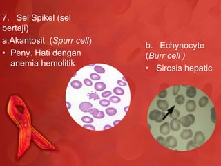 7. Sel Spikel (sel
bertaji)
a.Akantosit (Spurr cell)
                           b. Echynocyte
• Peny. Hati dengan        (Burr cell )
  anemia hemolitik
                           • Sirosis hepatic
 