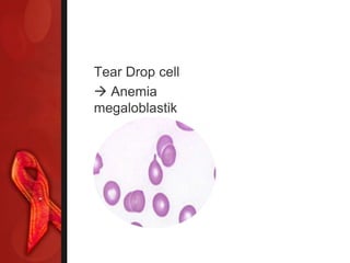 Tear Drop cell
 Anemia
megaloblastik
 