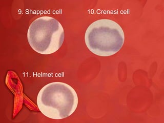 9. Shapped cell    10.Crenasi cell




 11. Helmet cell
 