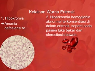 Kelainan Warna Eritrosit
1. Hipokromia             2. Hiperkromia hemoglobin
                          abnormal terkonsentrasi di
Anemia
                          dalam eritrosit, seperti pada
  defesiensi fe
                          pasien luka bakar dan
                          sferositosis bawan.
 