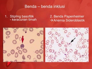 Benda – benda inklusi

1. Stipling basofilik     2. Benda Papenheimer
   - keracunan timah      Anemia Sideroblastik
 