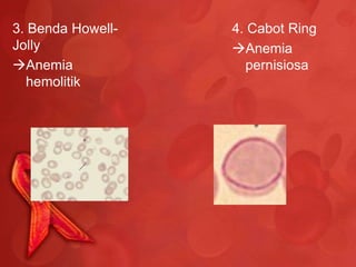 3. Benda Howell-   4. Cabot Ring
Jolly              Anemia
Anemia              pernisiosa
  hemolitik
 