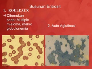 Susunan Eritrosit
1. ROULEAUX
Ditemukan
  pada: Multiple
  mieloma, makro        2. Auto Aglutinasi
  globulonemia
 