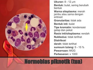 • Ukuran: 8 - 12 m
          • Bentuk: bulat, sering berubah
            bentuk
          • Warna sitoplasma: merah
            jambu atau sama dengan
            eritrosit
          • Granularitas: tidak ada
          • Bentuk inti: bulat
          • Tipe kromatin: kondensasi
            gelap dan pekat
          • Rasio inti/sitoplasma: rendah
          • Nukleolus: tidak terlihat
          • Distribusi
          • darah: tidak terlihat
          • sumsum tulang: 5 - 15 %
          • Pewarnaan: MGG
          • Perbesaran: x 1000


Normoblas piknotik (tua)
 