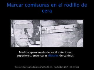 Marcar comisuras en el rodillo de
             cera




       Medida aproximada de los 6 anteriores
     superiores; entre caras distales de caninos



   Wehner, Hickey, Boucher. Selection of artiﬁcial teeth. J Prosthet Dent 1967; 18(3):222-232
 