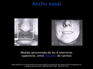 Ancho nasal




            Medida aproximada de los 6 anteriores
            superiores; entre cúspides de caninos


Mavroskouﬁs et al. Nasal width and incisive papilla as guides for the selection and arrangement of
                 maxillary anterior teeth. J Prosthet Dent 1981; 45(6):592-597
 