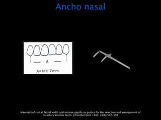 Ancho nasal




Mavroskouﬁs et al. Nasal width and incisive papilla as guides for the selection and arrangement of
                 maxillary anterior teeth. J Prosthet Dent 1981; 45(6):592-597
 