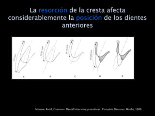La resorción de la cresta afecta
considerablemente la posición de los dientes
                 anteriores




        Morrow, Rudd, Eissmann. Dental laboratory procedures. Complete Dentures. Mosby, 1980.
 