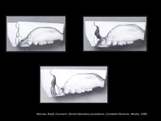 Morrow, Rudd, Eissmann. Dental laboratory procedures. Complete Dentures. Mosby, 1980.
 