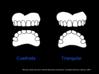 Cuadrada                                          Triangular

  Morrow, Rudd, Eissmann. Dental laboratory procedures. Complete Dentures. Mosby, 1980.
 
