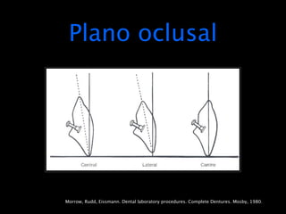 Plano oclusal




Morrow, Rudd, Eissmann. Dental laboratory procedures. Complete Dentures. Mosby, 1980.
 