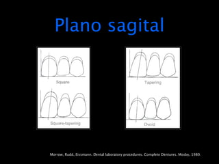 Plano sagital




Morrow, Rudd, Eissmann. Dental laboratory procedures. Complete Dentures. Mosby, 1980.
 