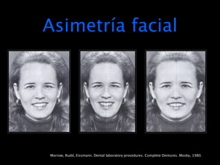 Asimetría facial




Morrow, Rudd, Eissmann. Dental laboratory procedures. Complete Dentures. Mosby, 1980.
 