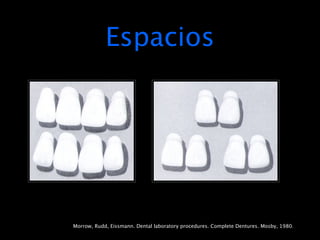 Espacios




Morrow, Rudd, Eissmann. Dental laboratory procedures. Complete Dentures. Mosby, 1980.
 