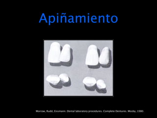 Apiñamiento




Morrow, Rudd, Eissmann. Dental laboratory procedures. Complete Dentures. Mosby, 1980.
 