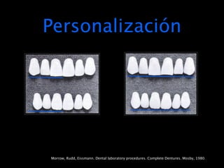 Personalización




Morrow, Rudd, Eissmann. Dental laboratory procedures. Complete Dentures. Mosby, 1980.
 