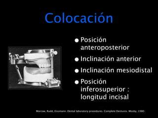 Colocación
                             • Posición
                                  anteroposterior

                             • Inclinación anterior
                             • Inclinación mesiodistal
                             • Posición
                                  inferosuperior :
                                  longitud incisal

Morrow, Rudd, Eissmann. Dental laboratory procedures. Complete Dentures. Mosby, 1980.
 