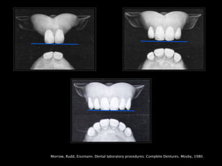 Morrow, Rudd, Eissmann. Dental laboratory procedures. Complete Dentures. Mosby, 1980.
 