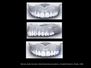 Morrow, Rudd, Eissmann. Dental laboratory procedures. Complete Dentures. Mosby, 1980.
 