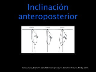 Inclinación
anteroposterior




Morrow, Rudd, Eissmann. Dental laboratory procedures. Complete Dentures. Mosby, 1980.
 