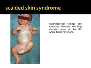 Staphylococcal scalded skin
syndrome. Neonate with large
denuded areas of the skin
where bullae have burst.
 