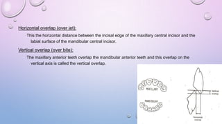 Horizontal overlap (over jet):
This the horizontal distance between the incisal edge of the maxillary central incisor and the
labial surface of the mandibular central incisor.

Vertical overlap (over bite):
The maxillary anterior teeth overlap the mandibular anterior teeth and this overlap on the
vertical axis is called the vertical overlap.

 