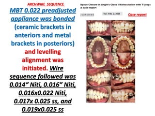 Selection Of Preformed Archwires During The Alignment Stage Of selection-of-preformed-archwires-during-the-alignment-stage-of