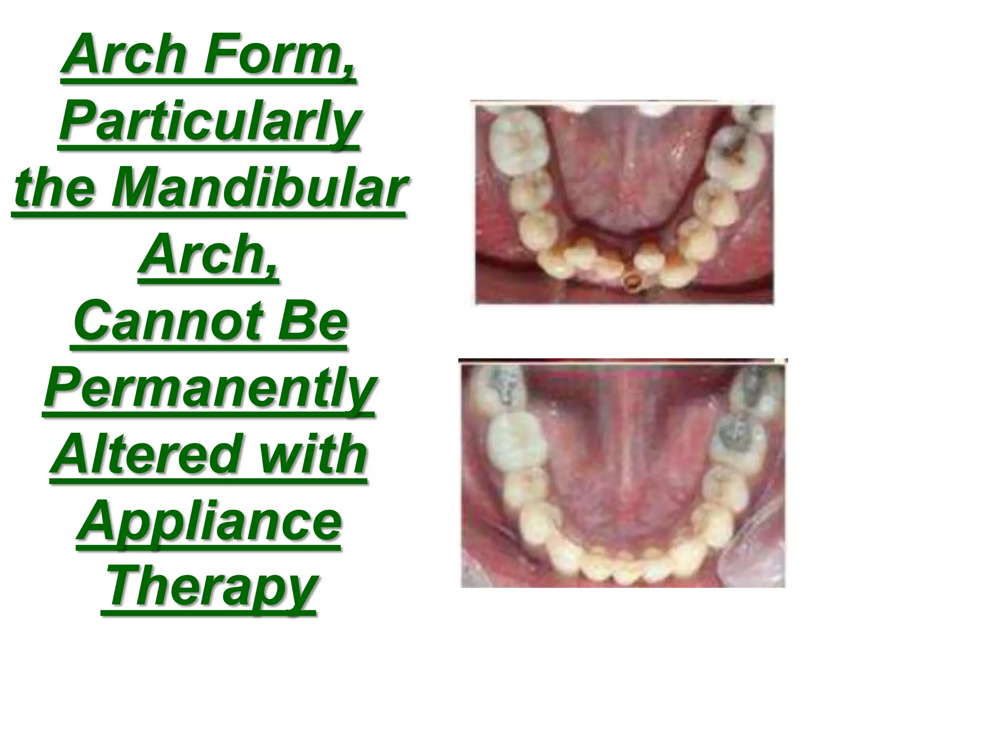 Arch Form,
Particularly
the Mandibular
Arch,
Cannot Be
Permanently
Altered with
Appliance
Therapy
 