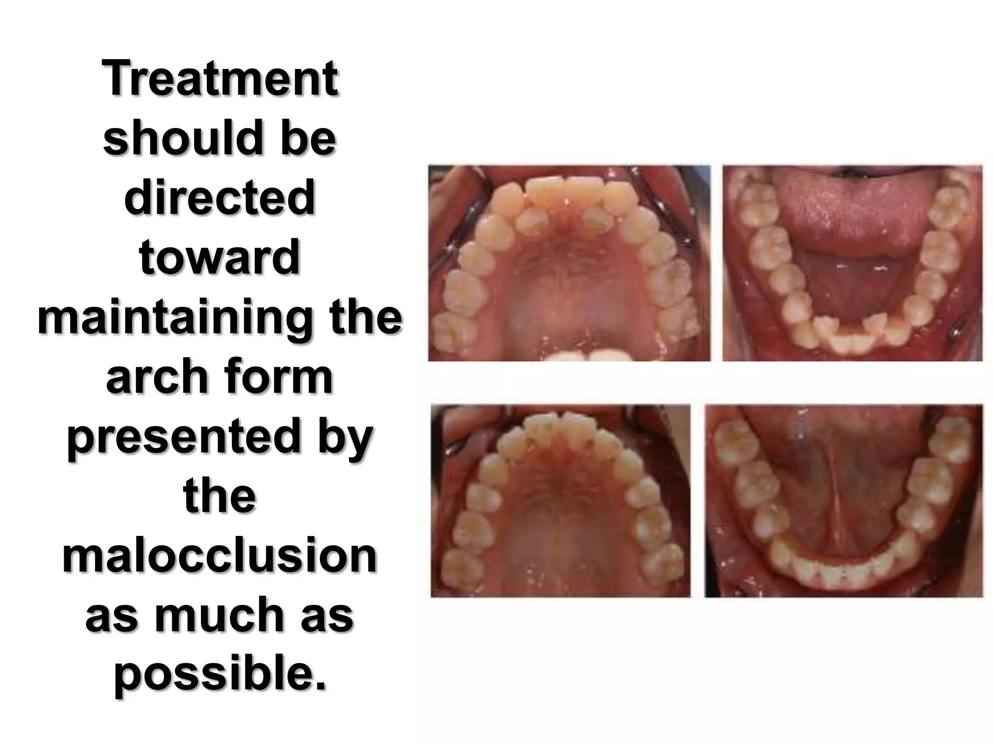 Treatment
should be
directed
toward
maintaining the
arch form
presented by
the
malocclusion
as much as
possible.
 