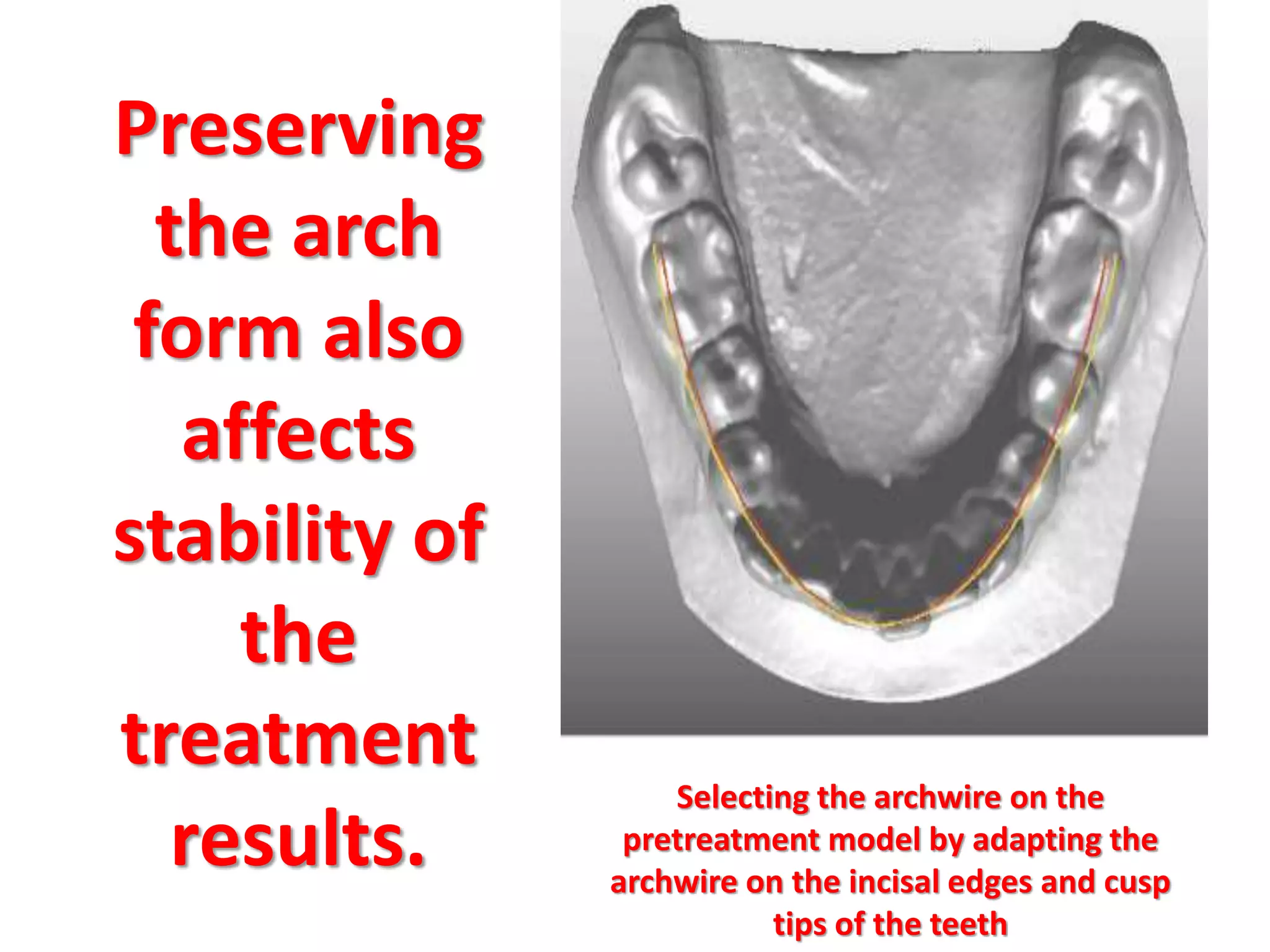 Preserving
the arch
form also
affects
stability of
the
treatment
results.
Selecting the archwire on the
pretreatment model by adapting the
archwire on the incisal edges and cusp
tips of the teeth
 