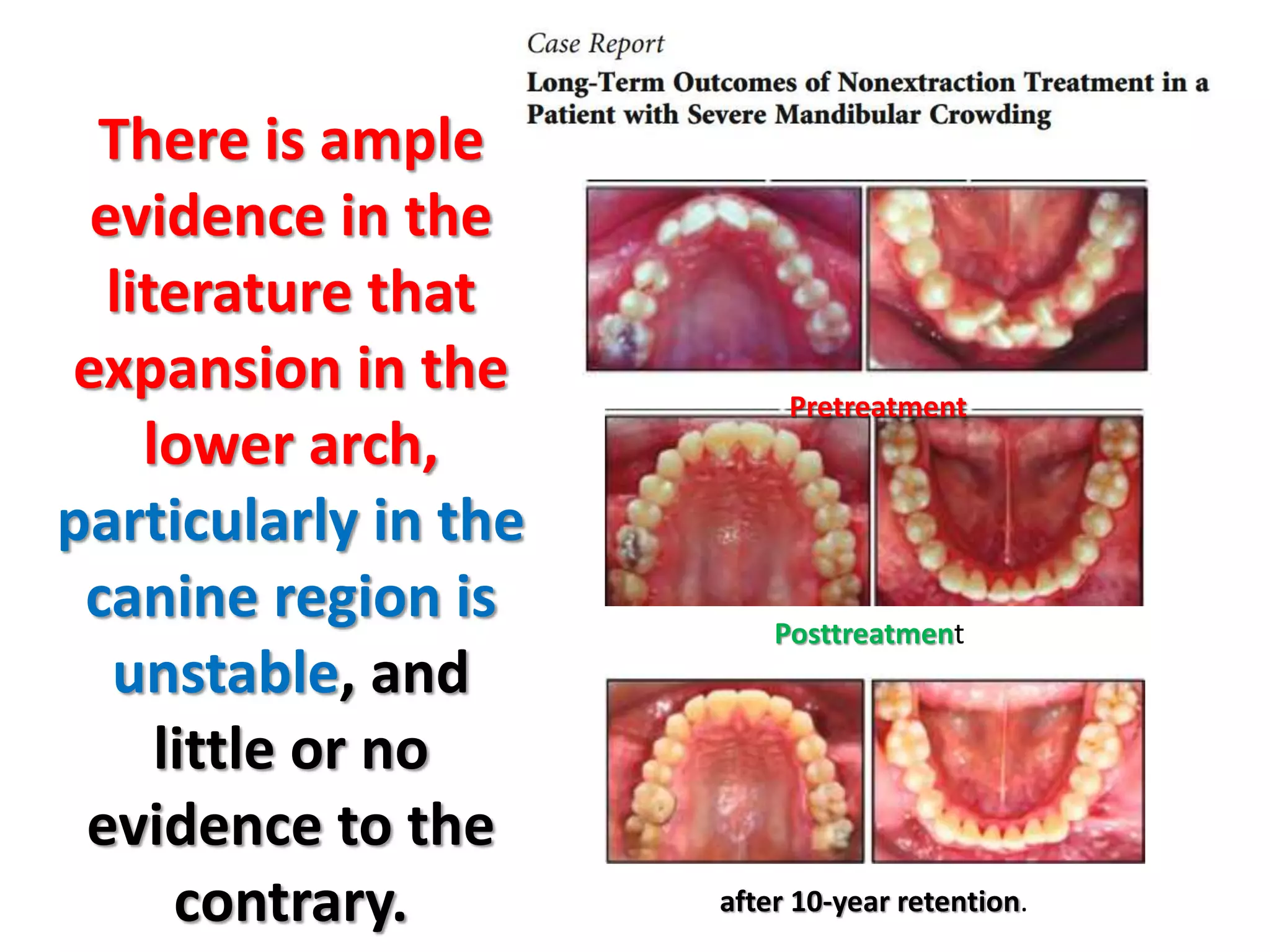 There is ample
evidence in the
literature that
expansion in the
lower arch,
particularly in the
canine region is
unstable, and
little or no
evidence to the
contrary.
Pretreatment
Posttreatment
after 10-year retention.
 