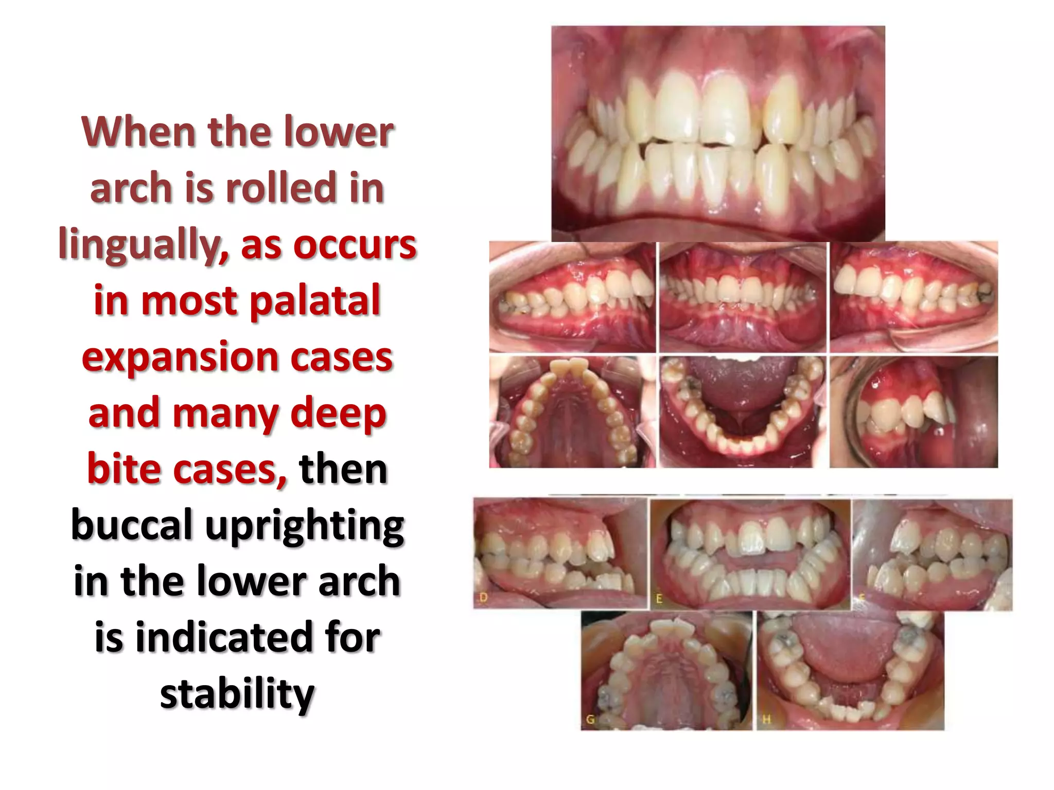 When the lower
arch is rolled in
lingually, as occurs
in most palatal
expansion cases
and many deep
bite cases, then
buccal uprighting
in the lower arch
is indicated for
stability
 