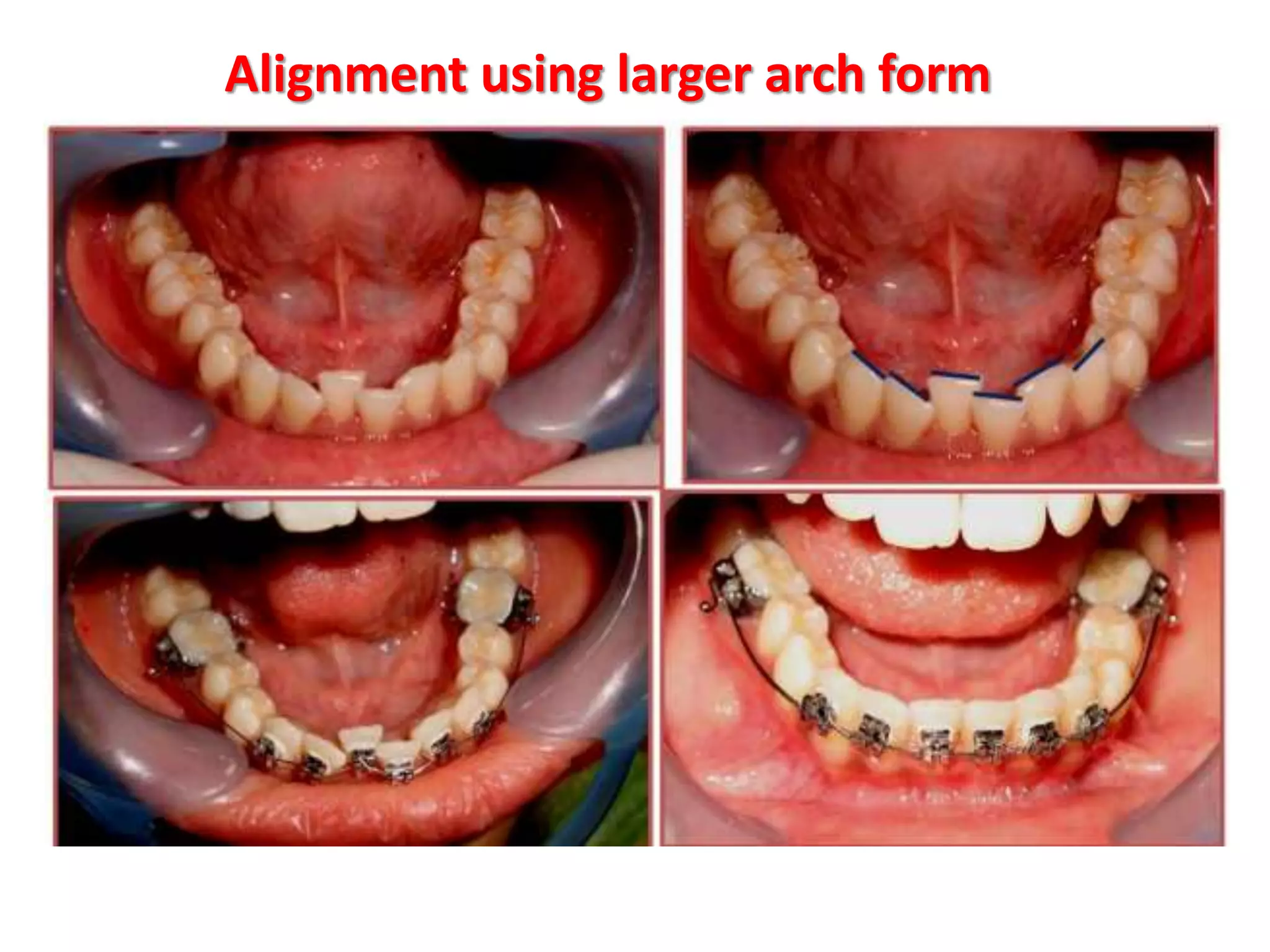 Alignment using larger arch form
 