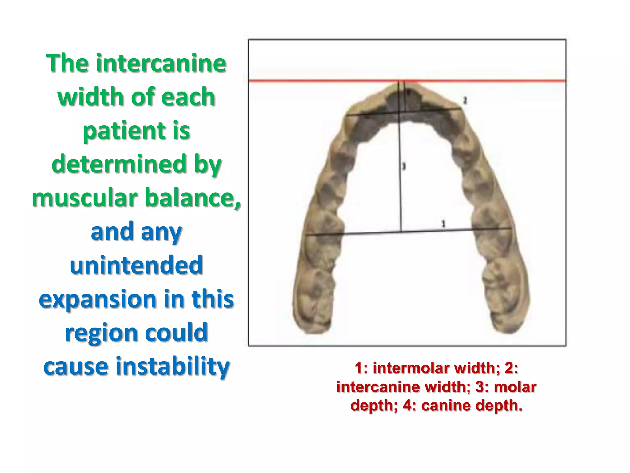 The intercanine
width of each
patient is
determined by
muscular balance,
and any
1: intermolar width; 2:
intercanine width; 3: molar
depth; 4: canine depth.
unintended
expansion in this
region could
cause instability
 