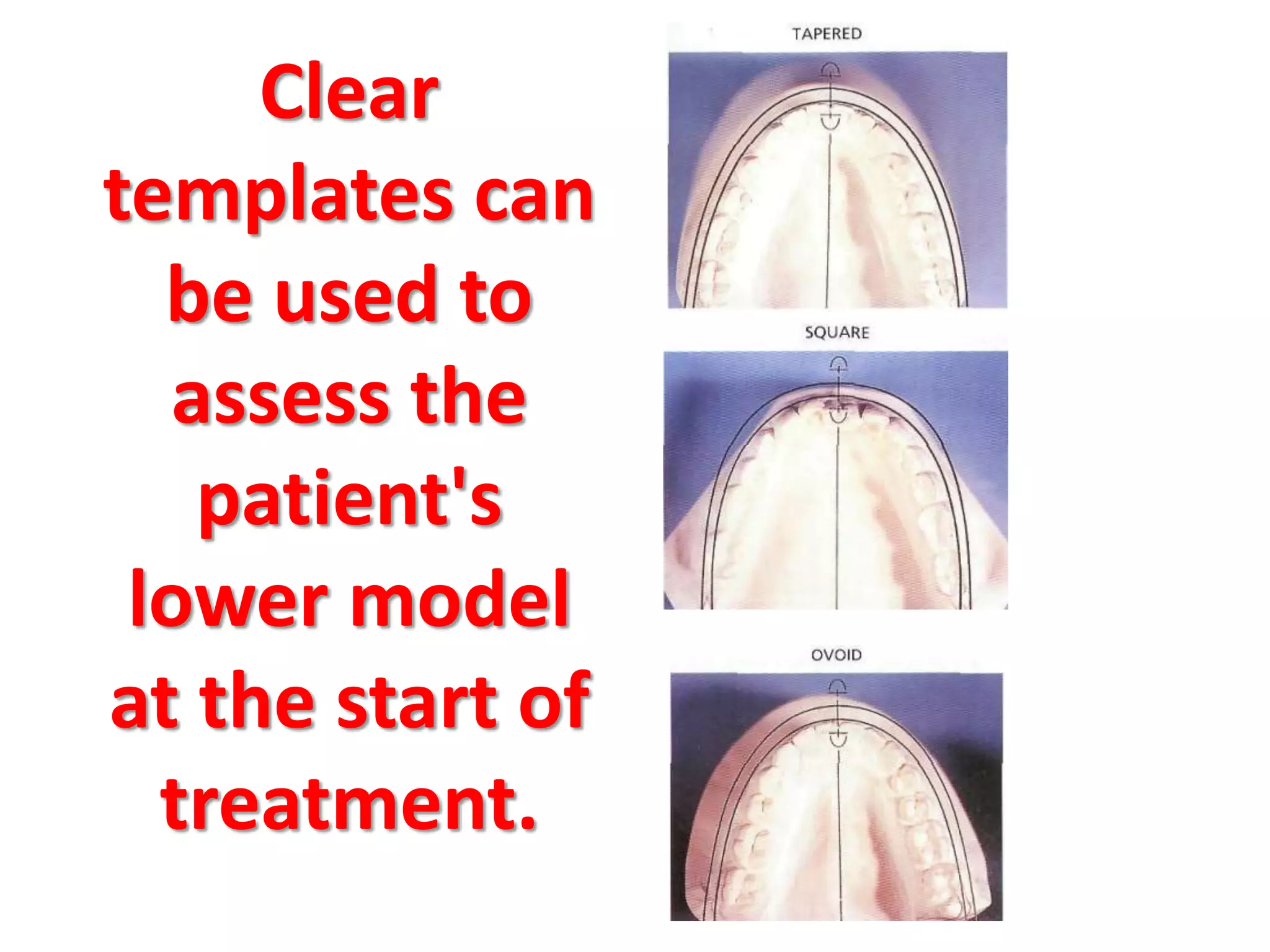 Clear
templates can
be used to
assess the
patient's
lower model
at the start of
treatment.
 