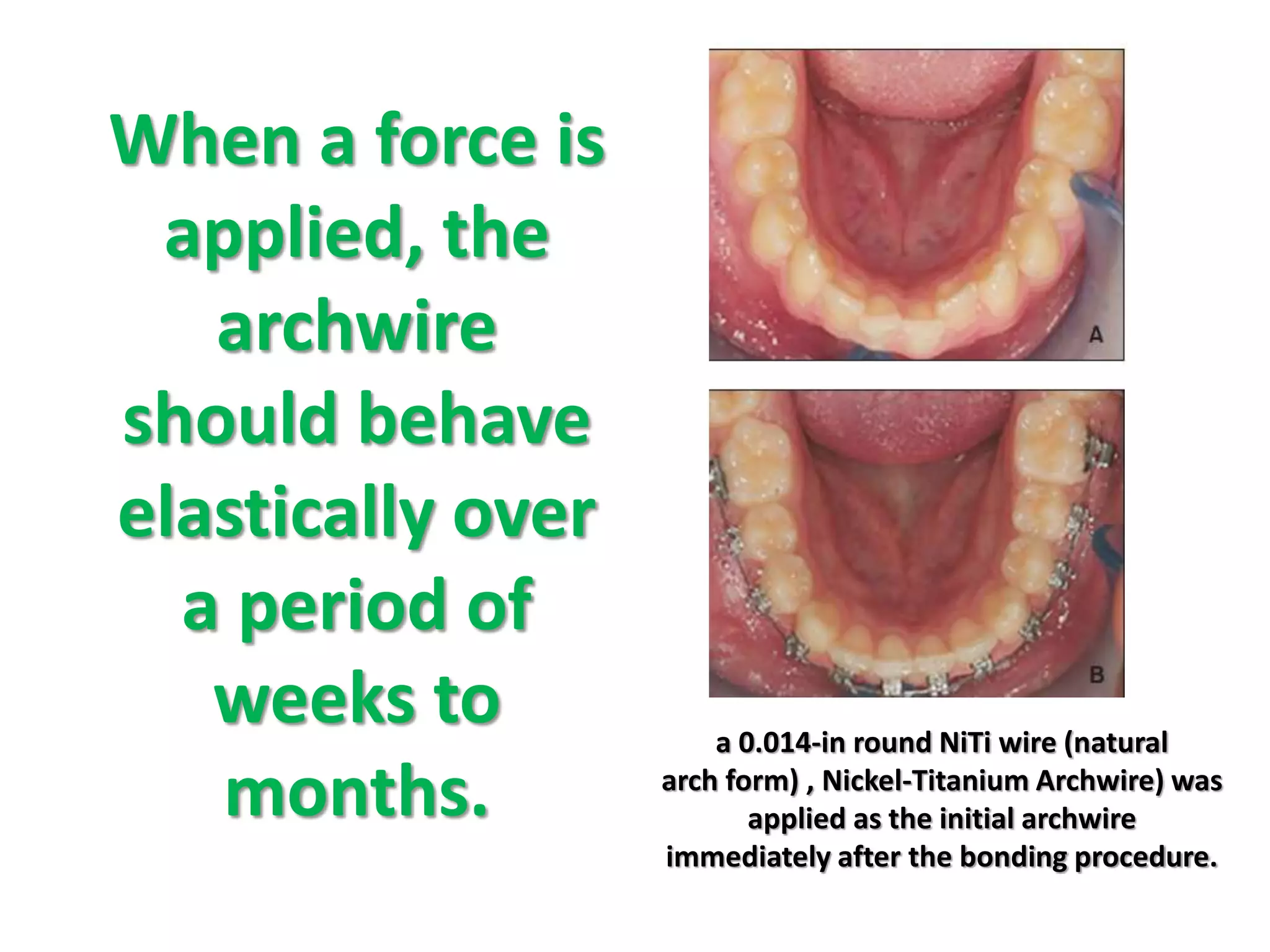 When a force is
applied, the
archwire
should behave
elastically over
a period of
weeks to
months.
.
a 0.014-in round NiTi wire (natural
arch form) , Nickel-Titanium Archwire) was
applied as the initial archwire
immediately after the bonding procedure.
 