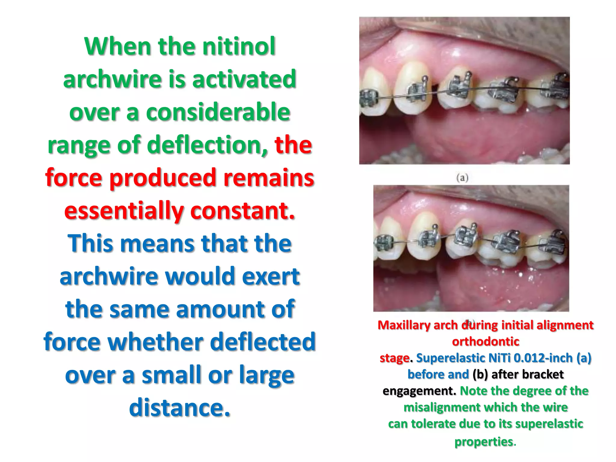 When the nitinol
archwire is activated
over a considerable
range of deflection, the
force produced remains
essentially constant.
This means that the
archwire would exert
the same amount of
force whether deflected
over a small or large
distance.
Maxillary arch during initial alignment
orthodontic
stage. Superelastic NiTi 0.012-inch (a)
before and (b) after bracket
engagement. Note the degree of the
misalignment which the wire
can tolerate due to its superelastic
properties.
 