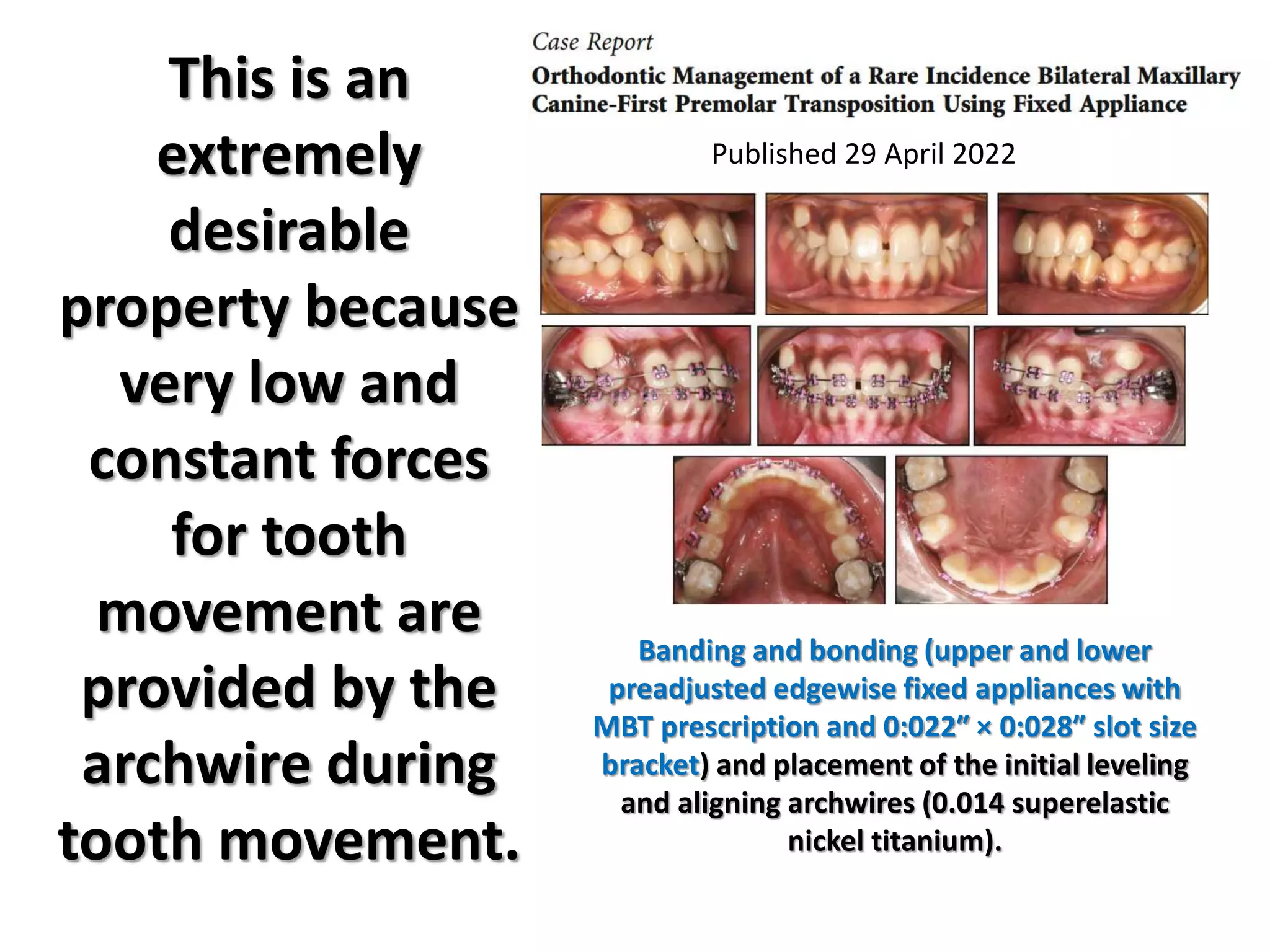This is an
extremely
desirable
property because
very low and
constant forces
for tooth
movement are
provided by the
archwire during
tooth movement.
Banding and bonding (upper and lower
preadjusted edgewise fixed appliances with
MBT prescription and 0:022″ × 0:028″ slot size
bracket) and placement of the initial leveling
and aligning archwires (0.014 superelastic
nickel titanium).
Published 29 April 2022
 