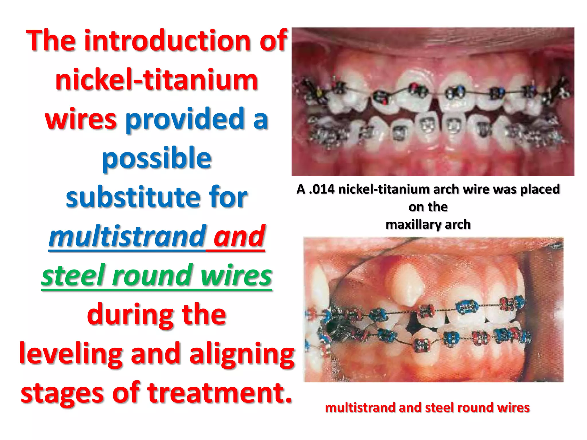 The introduction of
nickel-titanium
wires provided a
possible
substitute for
multistrand and
steel round wires
during the
leveling and aligning
stages of treatment.
A .014 nickel‐titanium arch wire was placed
on the
maxillary arch
multistrand and steel round wires
 