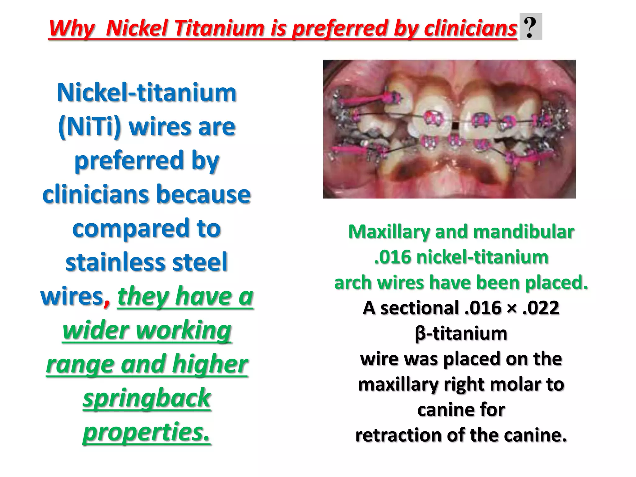 Nickel-titanium
(NiTi) wires are
preferred by
clinicians because
compared to
stainless steel
wires, they have a
wider working
range and higher
springback
properties.
Maxillary and mandibular
.016 nickel‐titanium
arch wires have been placed.
A sectional .016 × .022
β‐titanium
wire was placed on the
maxillary right molar to
canine for
retraction of the canine.
Why Nickel Titanium is preferred by clinicians
 