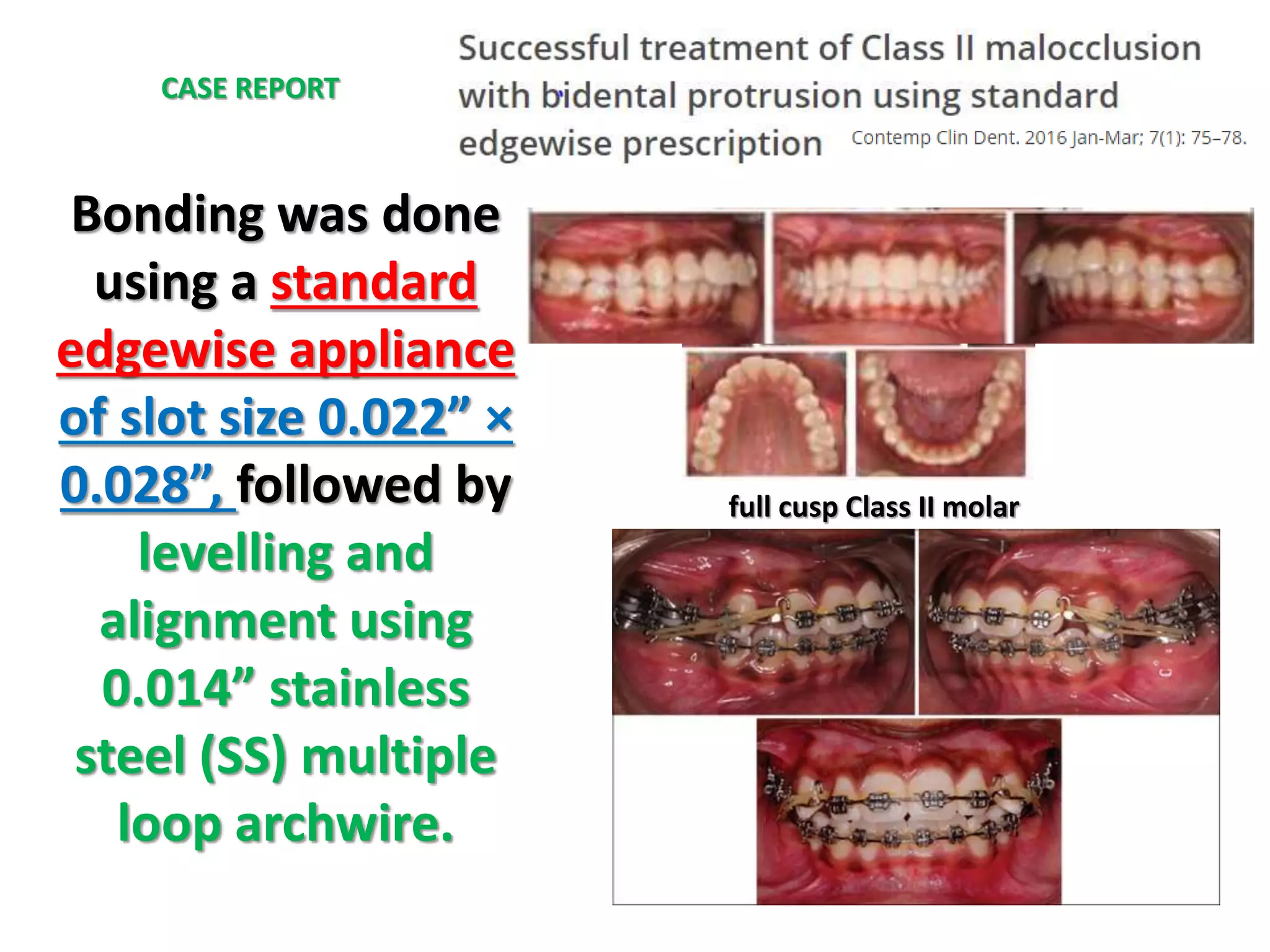 full cusp Class II molar
Bonding was done
using a standard
edgewise appliance
of slot size 0.022” ×
0.028”, followed by
levelling and
alignment using
0.014” stainless
steel (SS) multiple
loop archwire.
CASE REPORT
 