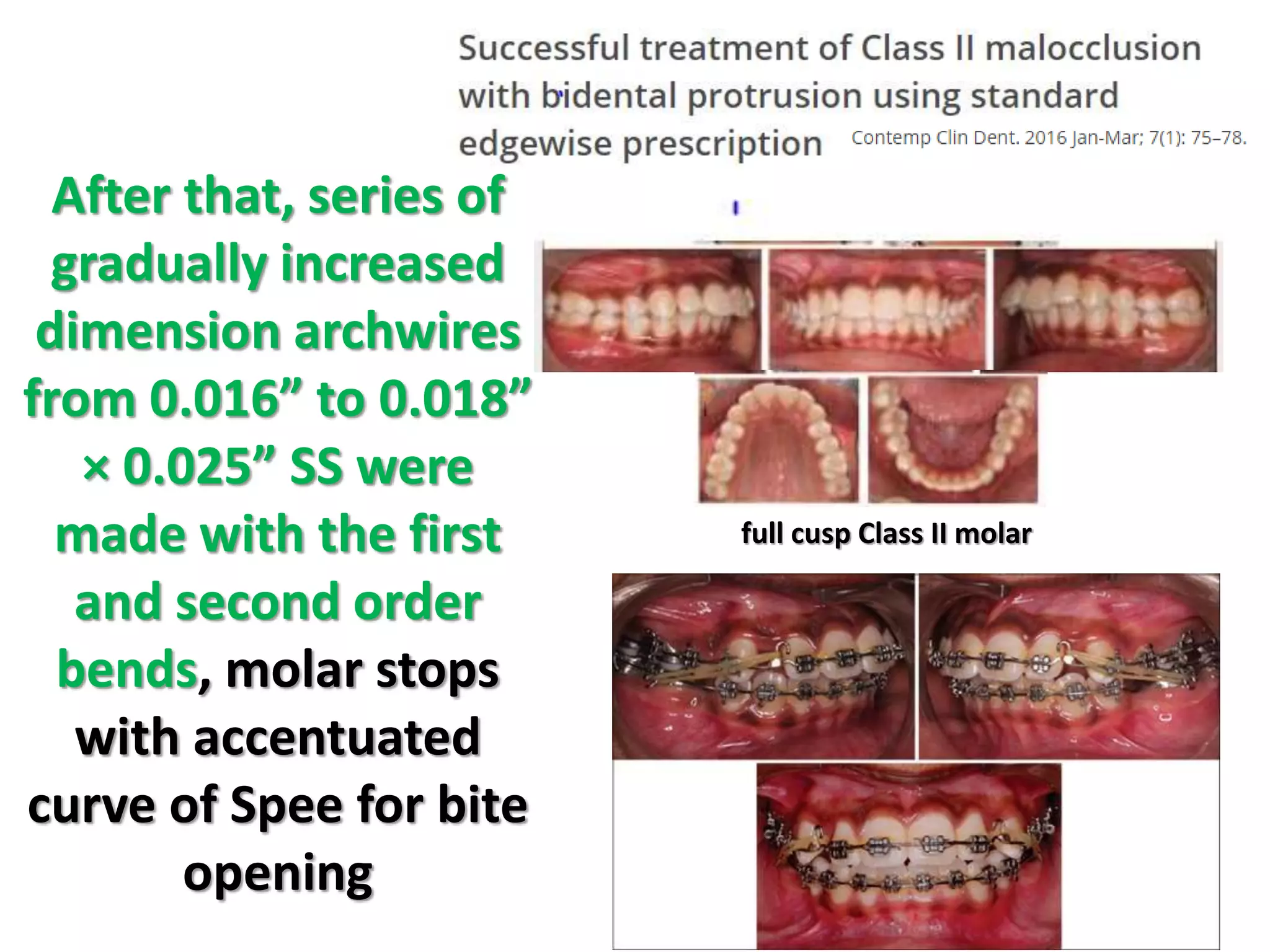 full cusp Class II molar
After that, series of
gradually increased
dimension archwires
from 0.016” to 0.018”
× 0.025” SS were
made with the first
and second order
bends, molar stops
with accentuated
curve of Spee for bite
opening
 