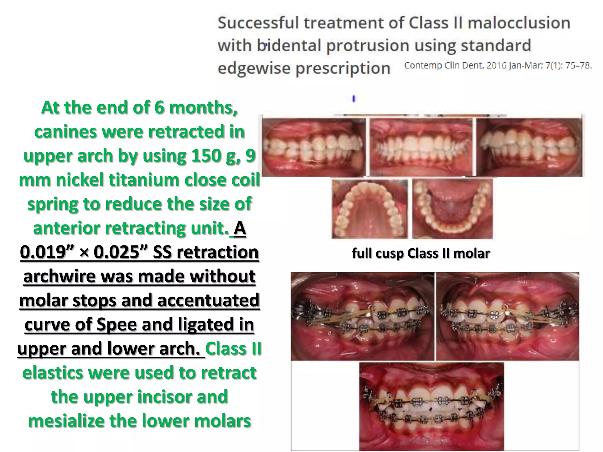 full cusp Class II molar
At the end of 6 months,
canines were retracted in
upper arch by using 150 g, 9
mm nickel titanium close coil
spring to reduce the size of
anterior retracting unit. A
0.019” × 0.025” SS retraction
archwire was made without
molar stops and accentuated
curve of Spee and ligated in
upper and lower arch. Class II
elastics were used to retract
the upper incisor and
mesialize the lower molars
 