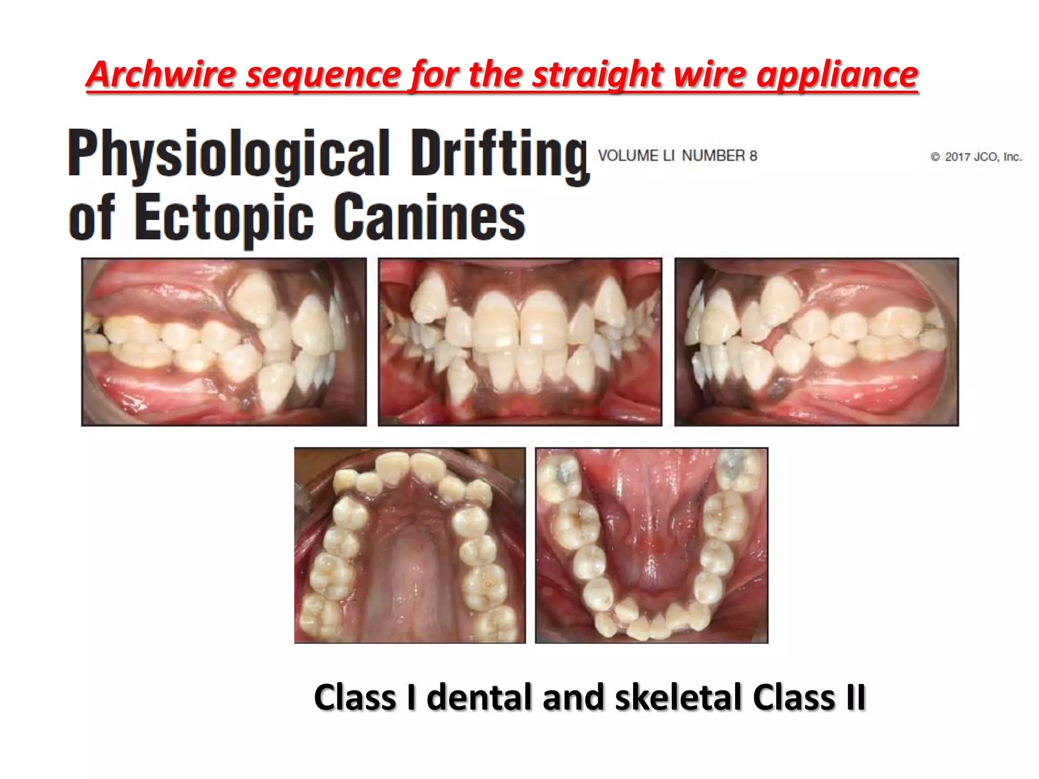 Archwire sequence for the straight wire appliance
Class I dental and skeletal Class II
 