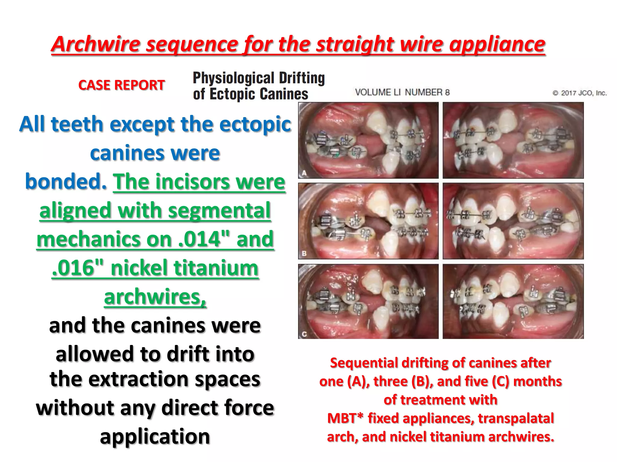 Archwire sequence for the straight wire appliance
All teeth except the ectopic
canines were
bonded. The incisors were
aligned with segmental
mechanics on .014" and
.016" nickel titanium
archwires,
and the canines were
allowed to drift into
the extraction spaces
without any direct force
application
Sequential drifting of canines after
one (A), three (B), and five (C) months
of treatment with
MBT* fixed appliances, transpalatal
arch, and nickel titanium archwires.
CASE REPORT
 